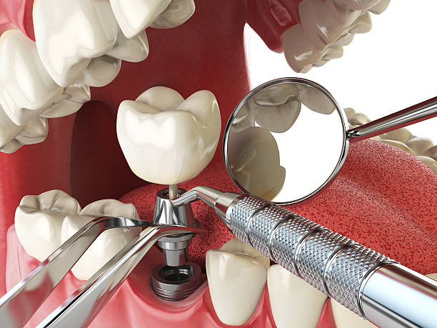 Best Emergency Dental Extractions in Roxboro, NC